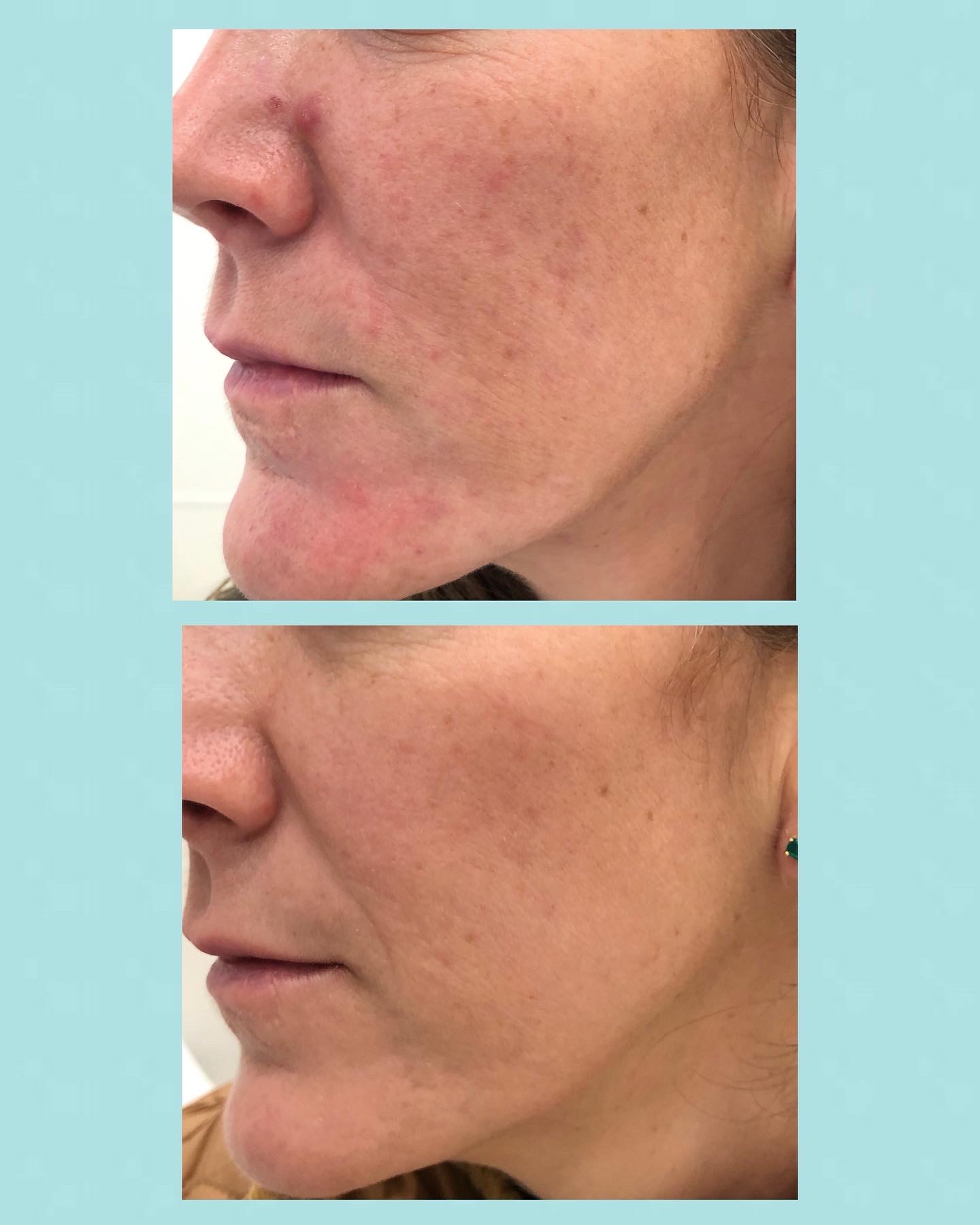 Rosácea - Casos clínicos